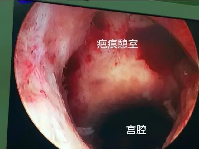 由于绒毛种植部位的瘢痕处无正常的内膜层和肌层,且位于两侧子宫动脉