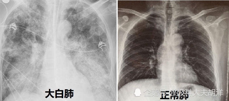 新冠患者出现"大白肺"就意味着生命倒计时,有效治疗