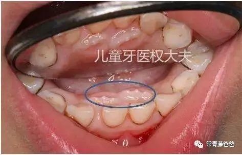 于是,两颗牙并排在岗(恒牙如下图蓝圈),就形成了双排牙