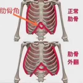 肋骨外翻可能是导致腰部粗壮的原因之一,改善它,才能练就小蛮腰