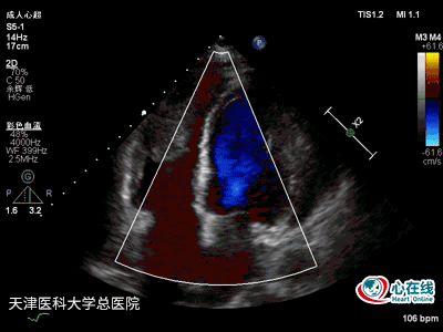 二维心尖四腔心切面示右心增大,右心室游离壁运动减弱,右心室内可见