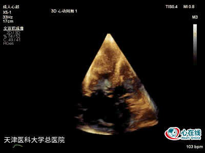 酷似肿瘤的巨大右心室赘生物一例