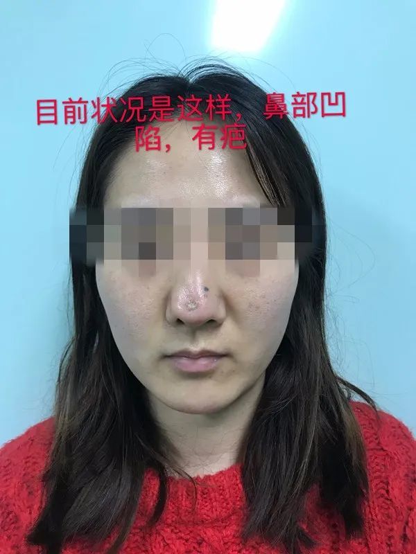 整容变毁容!濮阳一女士鼻内竟被偷放"假体,溃烂穿孔