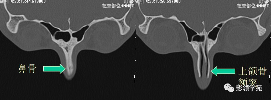 压痛 检查方法 x线平片:侧位 hrct 横断面:听眶下线 冠状面:鼻骨长轴