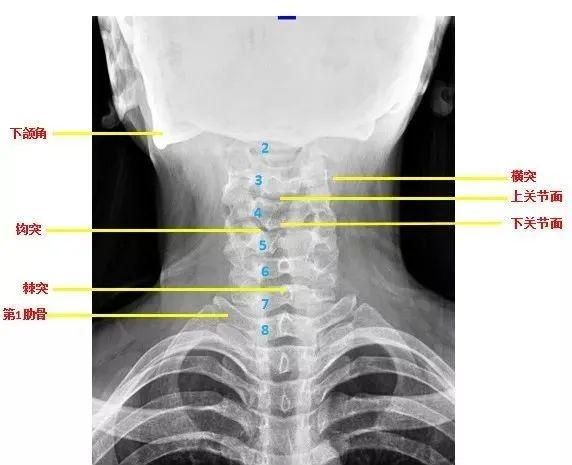 解剖是基础,先回顾一下颈椎的影像解剖 颈椎张口位解剖 1 曲度反弓