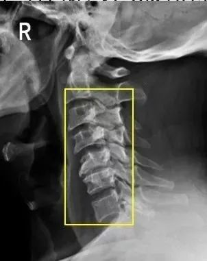 颈3-6 椎体前后缘见不同程度骨刺形成   第三步,观察钩突关节
