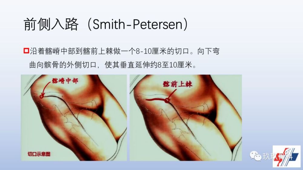 髋关节置换手术入路选择困惑