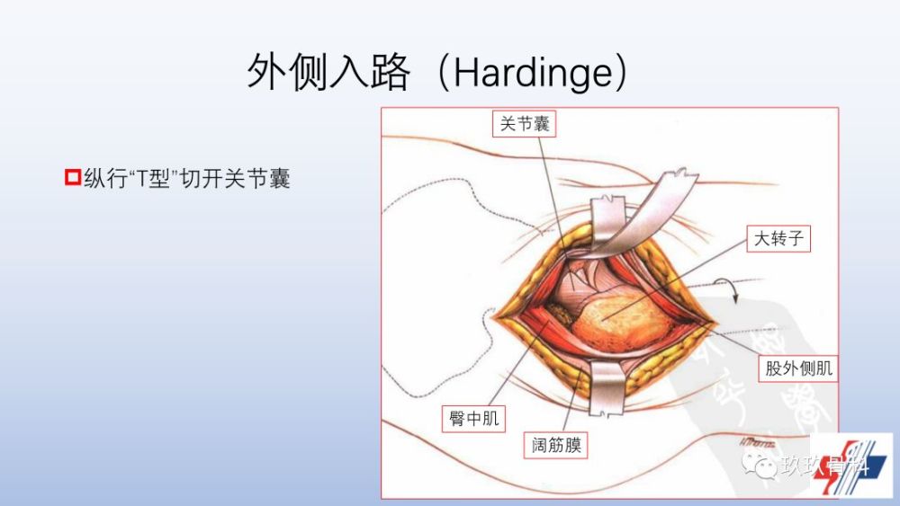 髋关节置换手术入路选择困惑