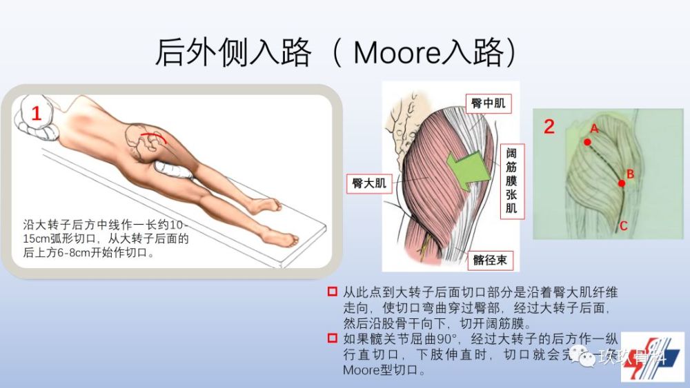 髋关节置换手术入路选择困惑