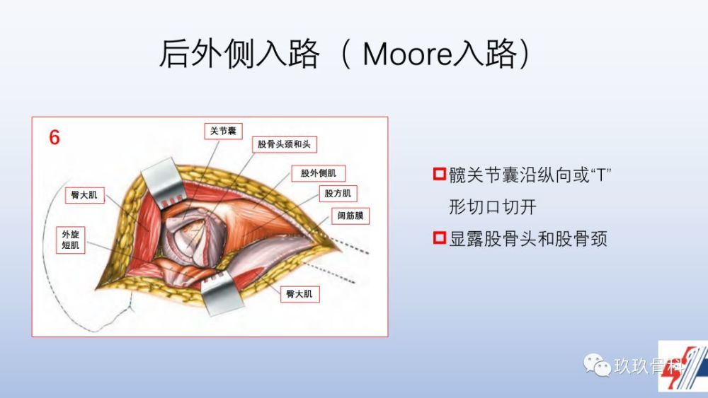 髋关节置换手术入路选择困惑