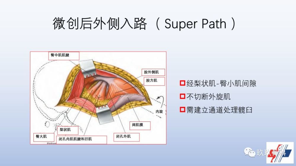 髋关节置换手术入路选择困惑