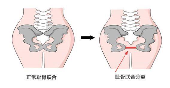 耻骨联合分离在怀孕晚