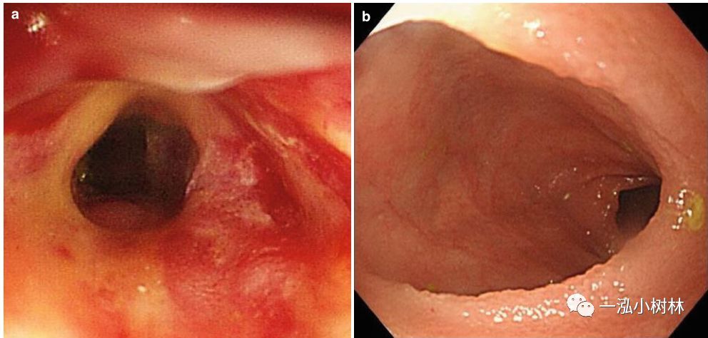 严重狭窄伴溃疡.内镜检查直径9.