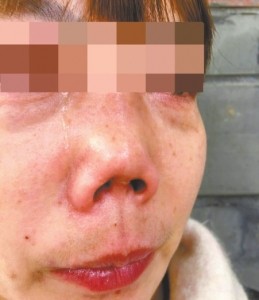 女子花6万多被整成"朝天鼻 院方:非手术造成