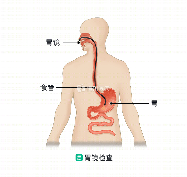 胃总是不舒服,怀疑胃癌怎么办?专家:别慌,牢记这3点,更好确认病情