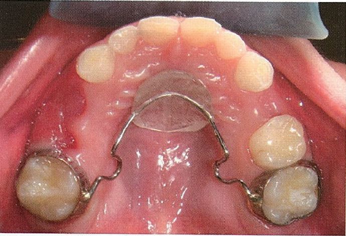 可制作nance弓保持器; 双侧下颌第二乳磨牙早失,可制作舌弓间隙保持器