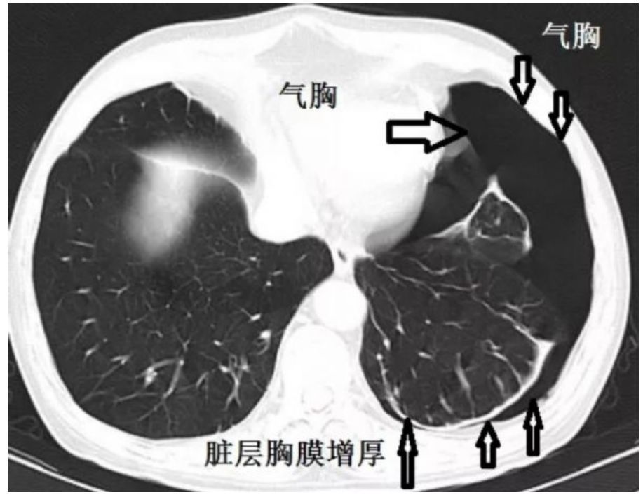 diss教科书大量气胸竟能保守治疗