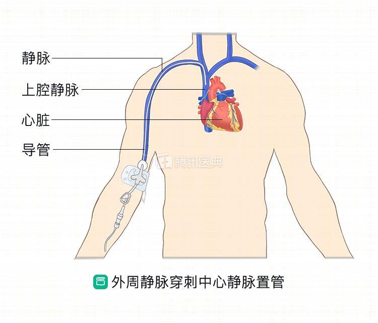 导管头端置于上腔静脉,部分血管可以在超声导引系统