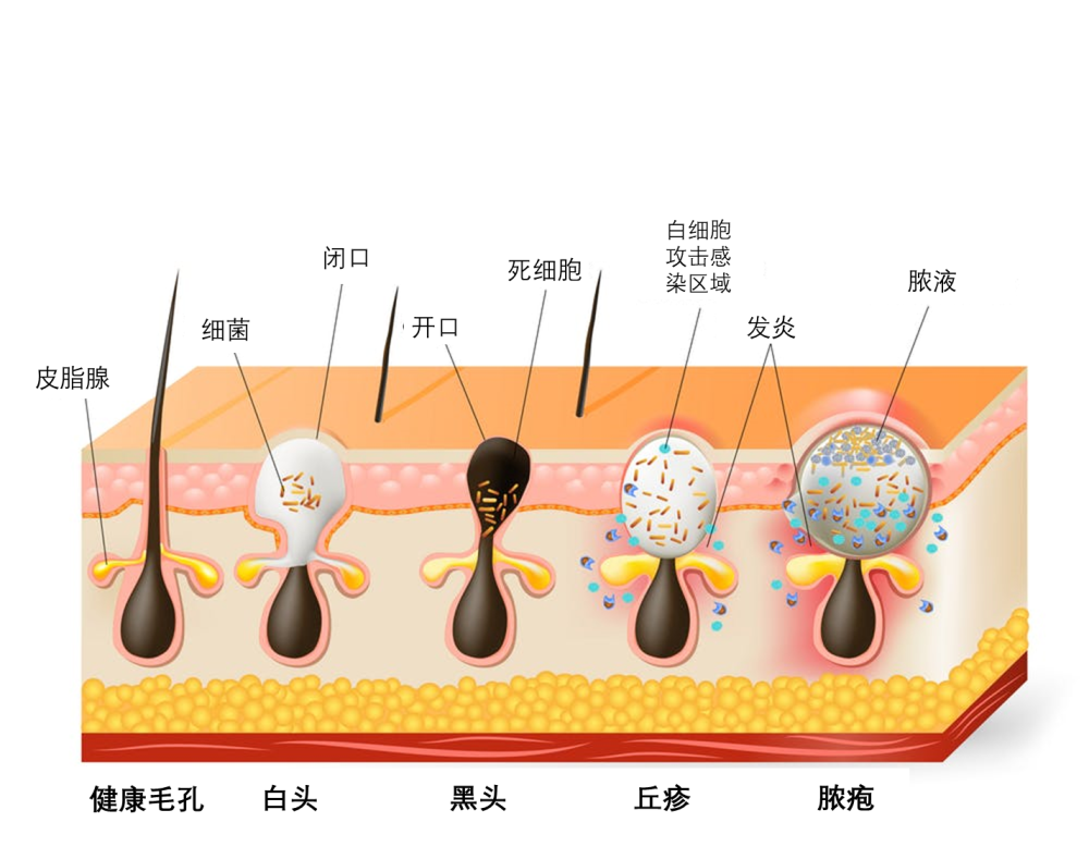 痤疮(青春痘)产生,图片取自网络