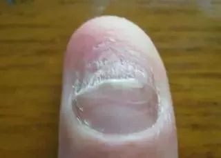(灰指甲)凭借以上两点,基本上就能很好区分银屑病甲和灰指甲了.