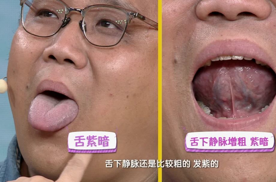 血瘀体质人,舌头的颜色偏暗,甚至发紫,舌下静脉较粗,且呈紫色.