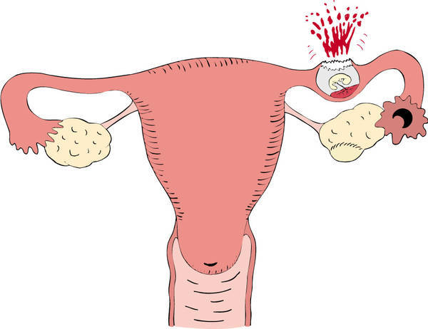 2. 宫外孕的症状