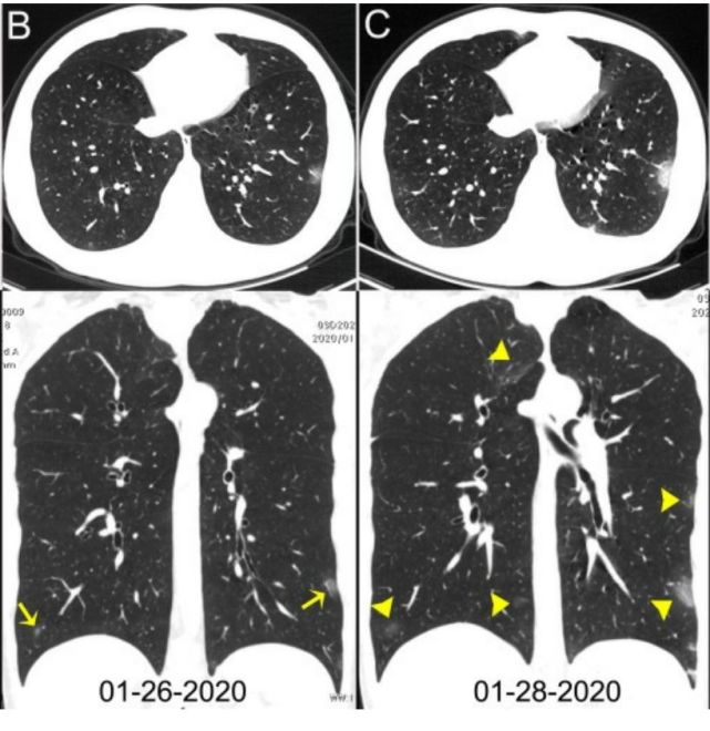 图3 影像学上鉴别肺癌还是很有必要的,某人不体检,万一他之前就有磨