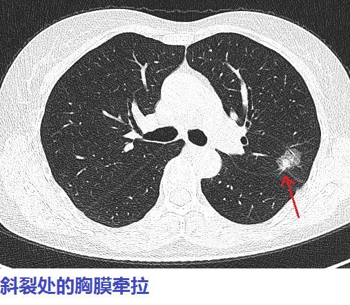 看胸膜有无牵拉