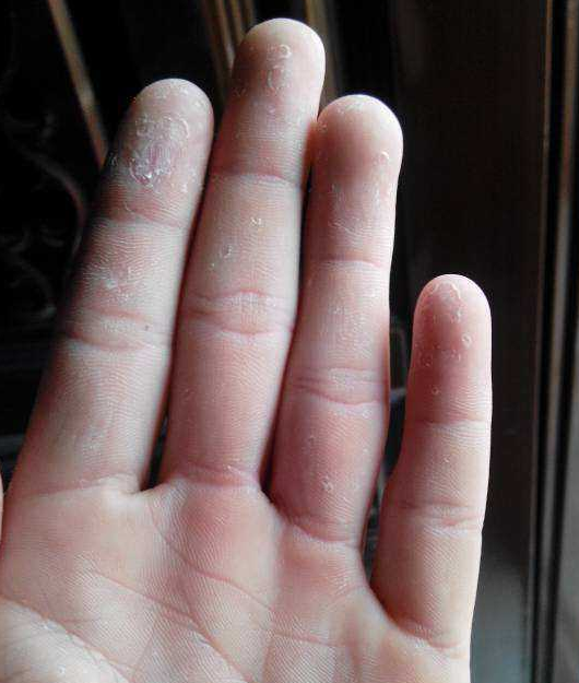 手指"脱皮"是什么造成的?其实是身体发出的"求救信号"