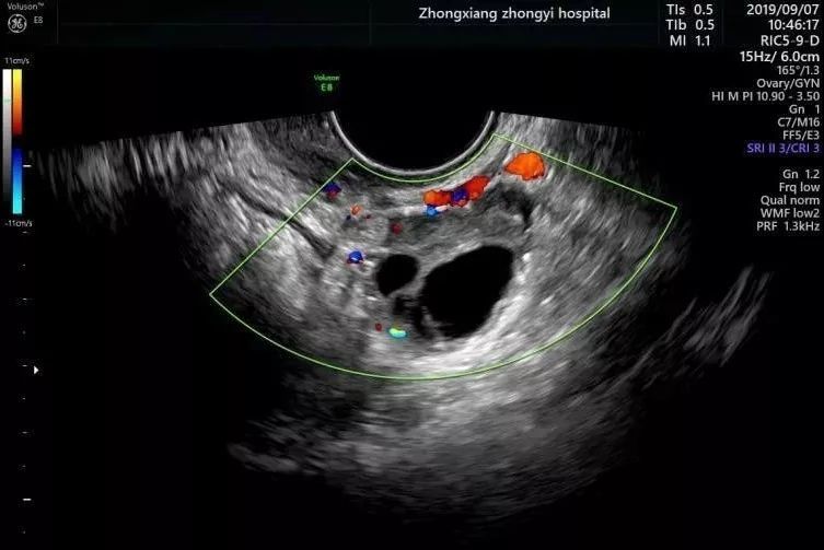 二维超声示左侧卵巢