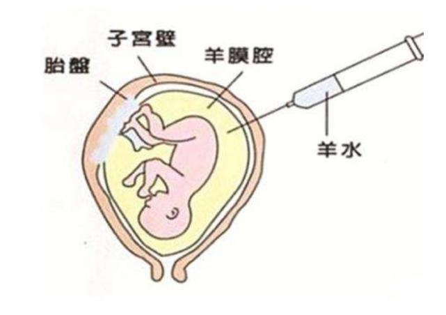 4类孕妈易怀唐氏儿,孕妈要小心,用这2种筛查,比唐筛更