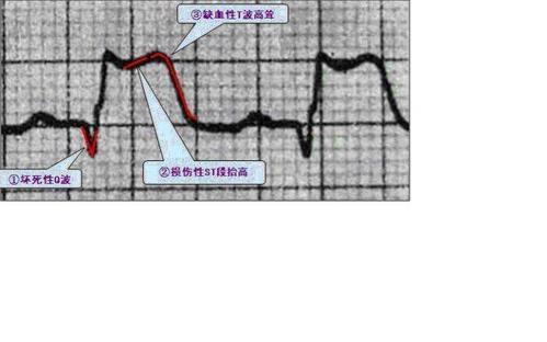 临床心电图:st段抬高的常见病因分析及处理