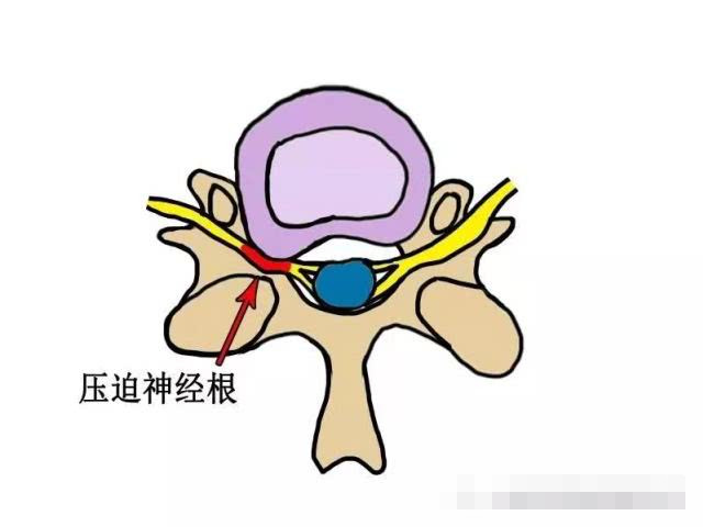 颈椎间盘侧后方突出,椎体间关节的增生,肥大等,使得其间走行的神经根