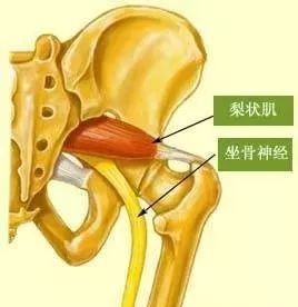 腰腿痛|梨状肌|肌肉|臀部|梨状肌综合症