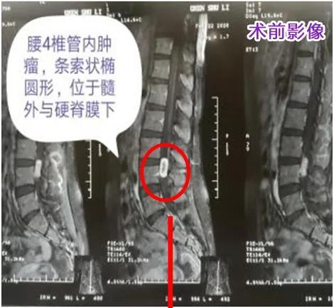 19岁少女,突然腰痛,竟是腰椎管肿瘤惹的祸!