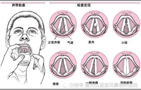 重庆弘医堂医院解析:患有声带小结的四个症状