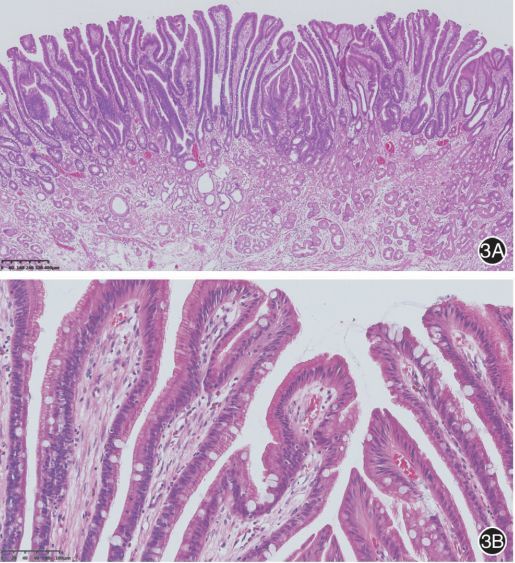 日本胃腺瘤及早期高分化腺癌的病理诊断