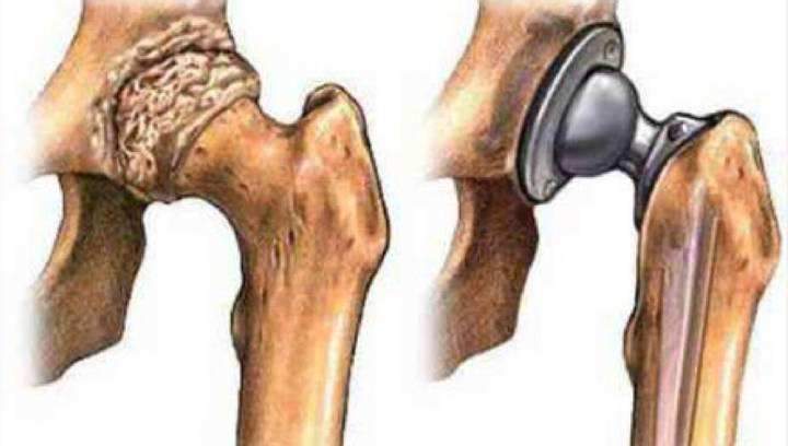 股骨头坏死髋关节置换术