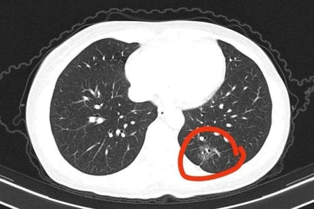 刘女士ct影像图中,肺癌病灶像瞪着两只"坏眼睛" 早期肺癌生存率达95%