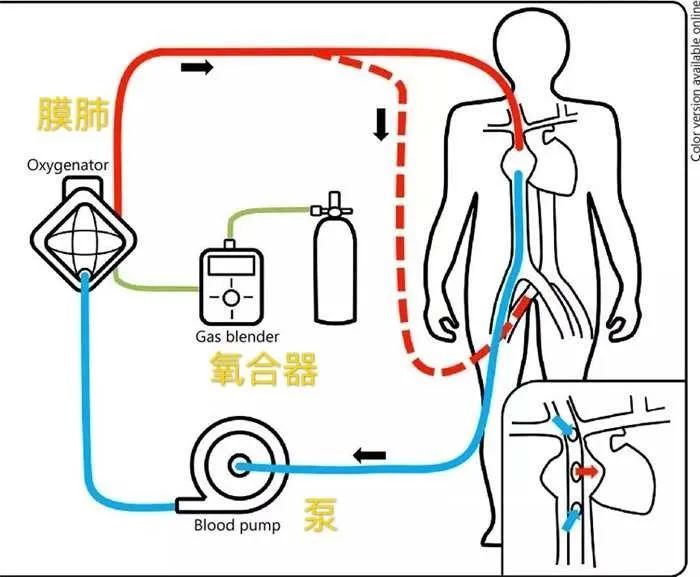 患者心肺功能明显好转,1月16日19:00,ecmo顺利脱机.