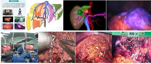 肝脏手术特色: (1)术前评估:肝功能child分级在b级以上,吲哚氰绿排泄