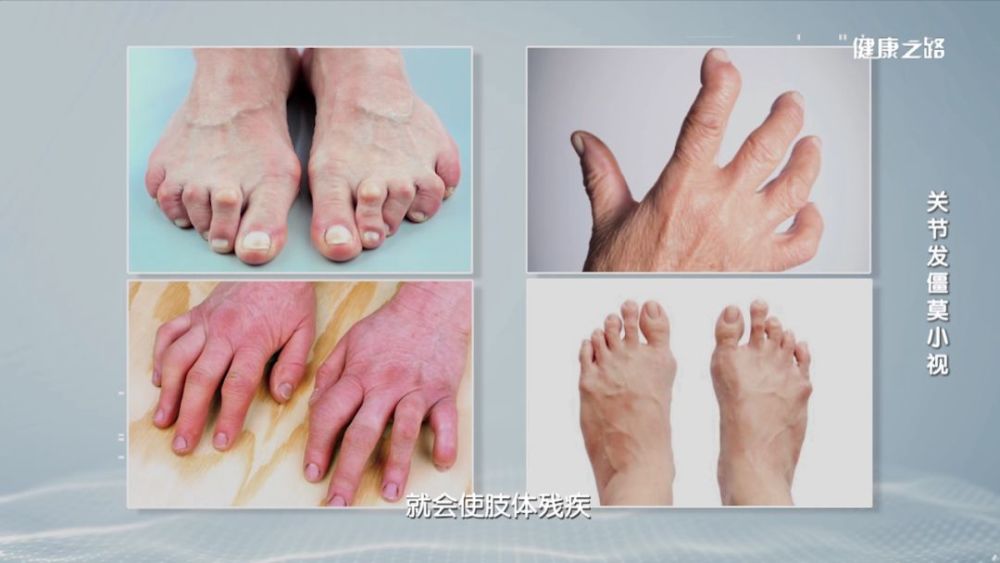 晨僵,关节变形,疼痛难忍?可能是类风湿关节炎作祟!
