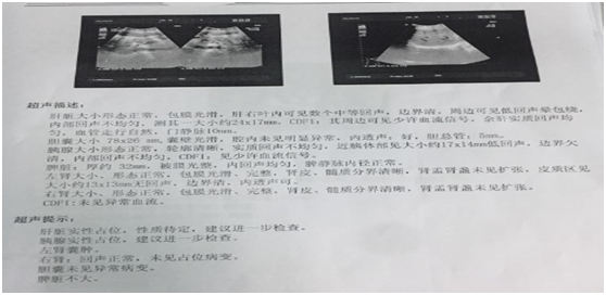 新发糖尿病并胰腺癌,该归于哪型?