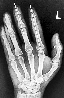 ���޳��������ɷ�ӵ���ָ ��ָ���峬12Сʱ����ֲ�ɹ�