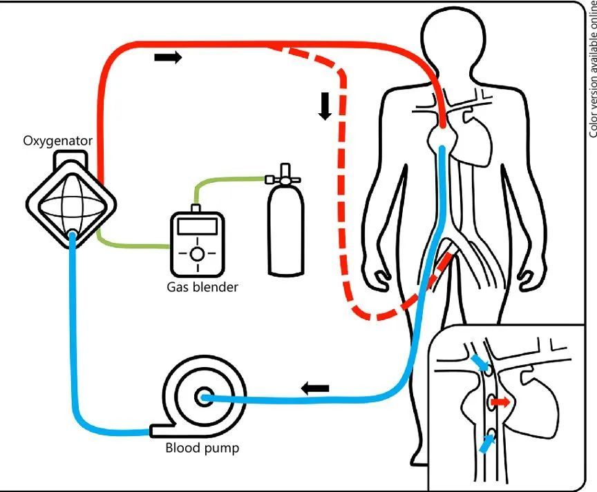 向死神要生命的ecmo:重症监护病房里的终极武器