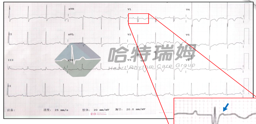 这种心电图形似肺栓塞,极易误诊!