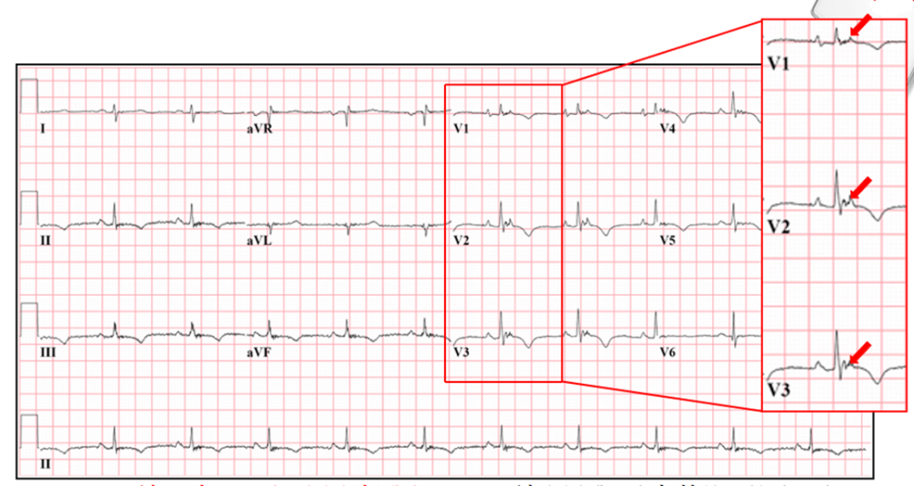 这种心电图形似肺栓塞,极易误诊!