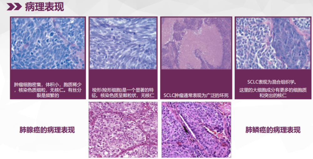 小细胞肺癌的病理切片,从显微镜下可以看到,其细胞核染色深,异形显著