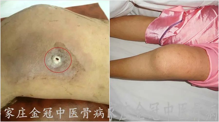 只是疼痛的骨结核需要局部针对治疗吗?看看专家怎么说