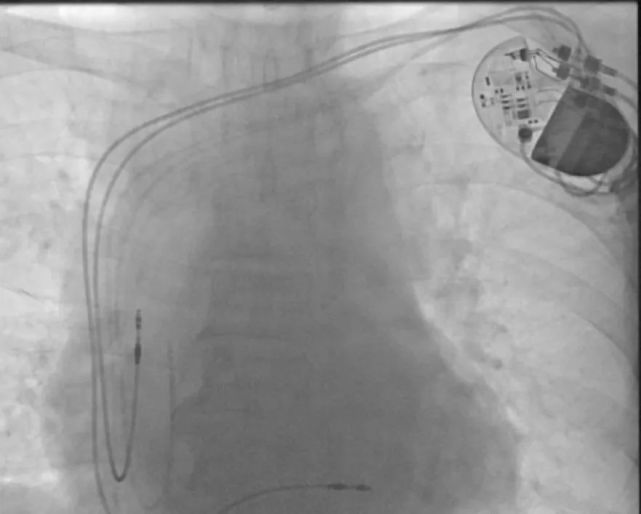 【宁医脉动】完成介入手术14例,其中,心脏起搏器安装术1例.